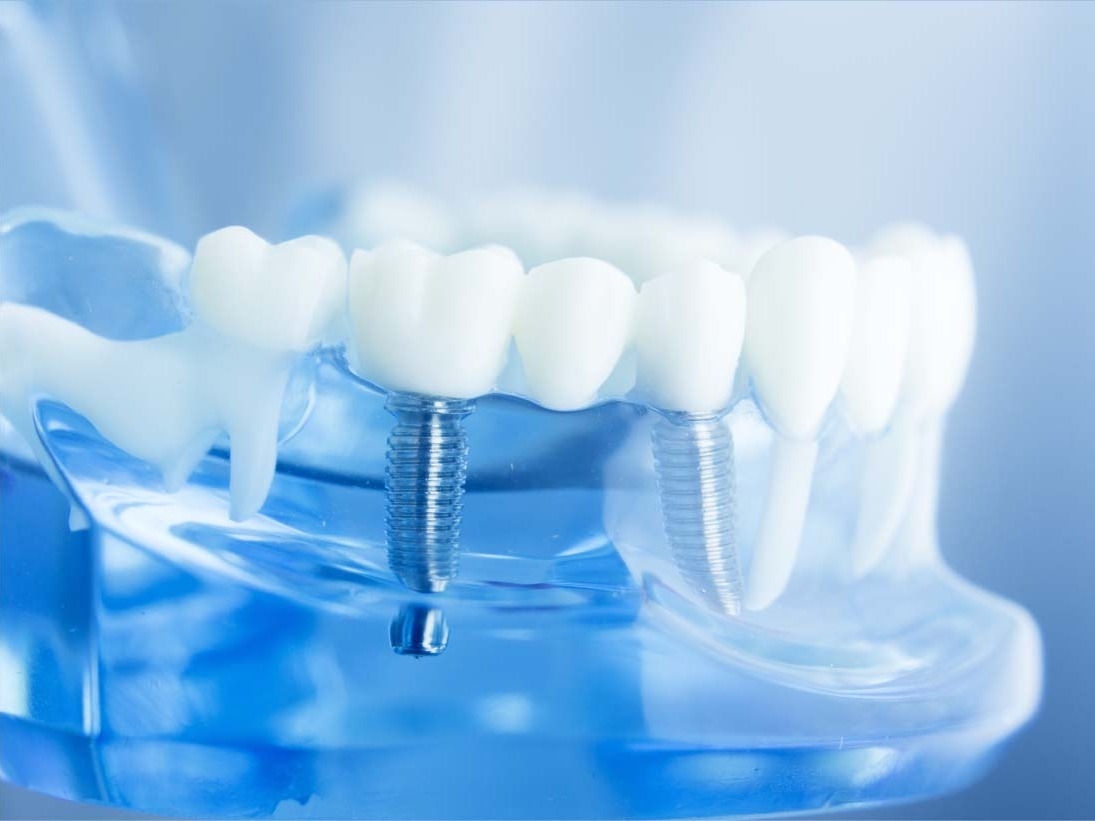 زراعة الاسنان في الاردن كم تكلف