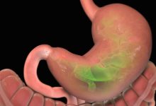 كم تكلفة عملية تكميم المعدة