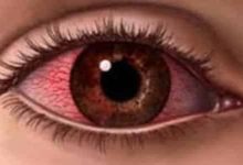 تفسير رؤية العين المصابة في المنام