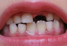 تفسير رؤية سقوط الأسنان الامامية