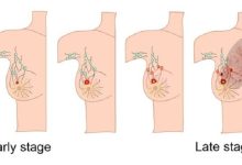 تجربتي مع تليف الثدي