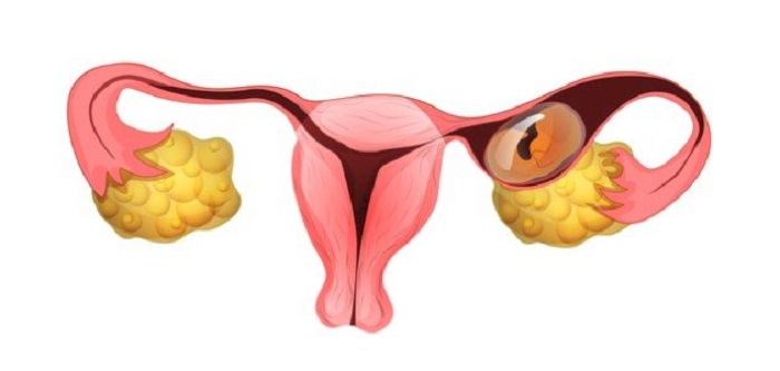 كيف اعرف ان الحمل خارج الرحم