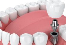 تجاربكم مع زراعة الاسنان الفورية وما مدى فعاليتها