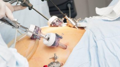 تجربتي الفاشلة مع التكميم