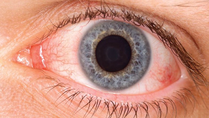 أهم أعراض جفاف العين الشديد وكيفية علاجه والتخلص منه منزلياً