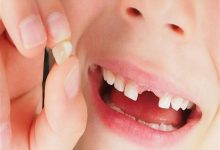 هل يوجد علاج لتثبيت الاسنان المخلخلة ؟ نعم واليك الحل