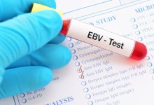 تجربتي مع فيروس ebv